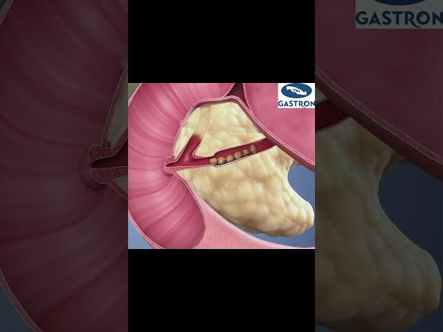 Pancreas stone removal by ERCP : Dr Vikas Singla #pancreas #chronicpancreatitis