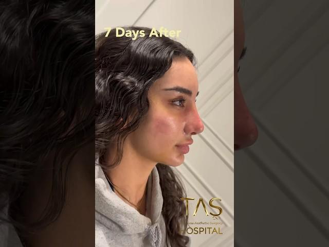 Scarless Facelift and Revision Rhinoplasty by Dr.TAS