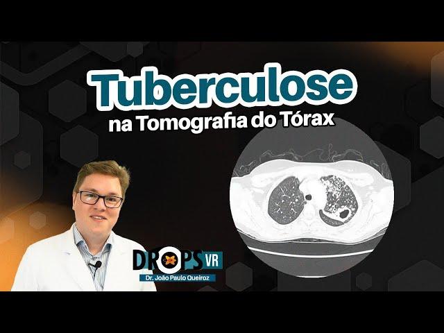 TUBERCULOSE NA TOMOGRAFIA DO TÓRAX I VOCÊ RADIOLOGISTA