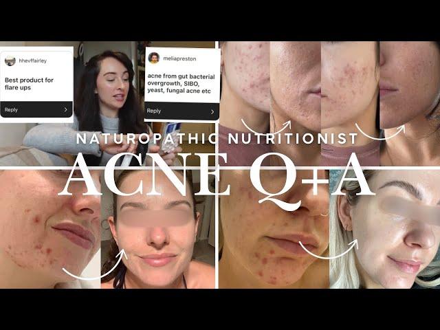 ACNE Q+A  Naturopathic Nutritionist + Acne Specialist