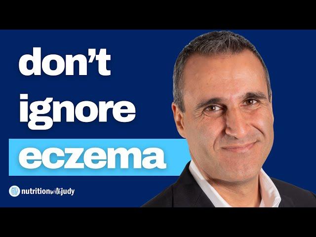 How Eczema, Allergies, Asthma and Neurological Imbalances are All Related – Dr. Pejman Katiraei