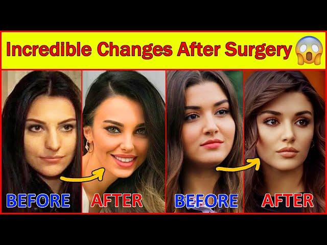 20 Turkish Actresses Before and After Surgery , Plastic Surgery, Turkish Drama