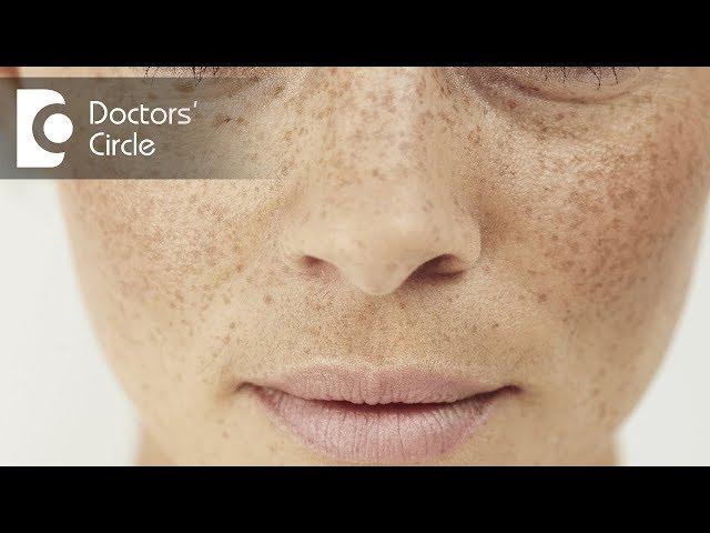 What is Pigmentation and how can you treat it? - Dr. Aruna Prasad