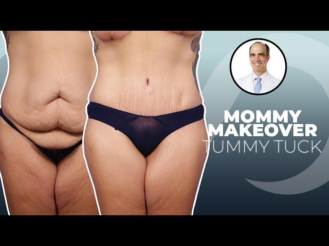 How a Mommy Makeover Changed My Life | Dr. David Stoker