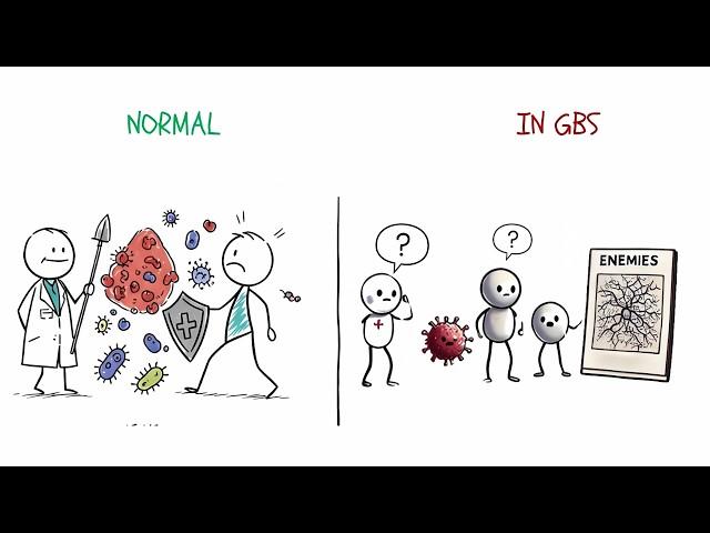 Guillain-Barre Syndrome (GBS) Explained