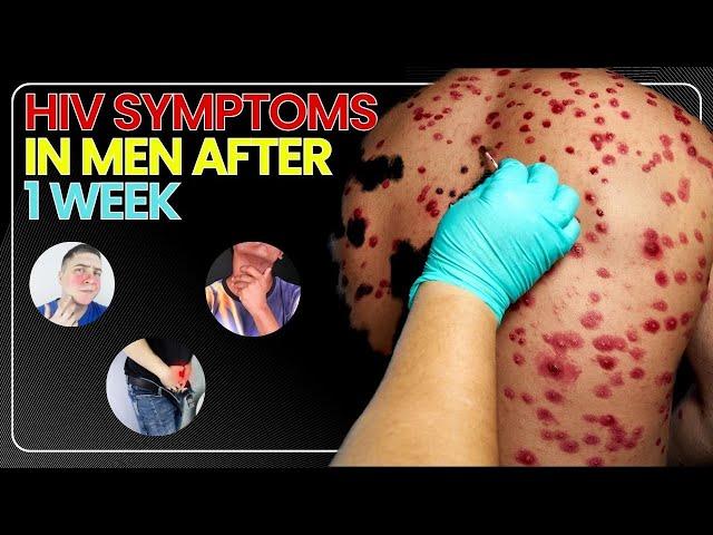 HIV Symptoms in Men After 1 Week