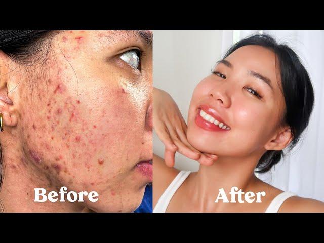 (ENG SUB) HOW I GOT RID OF MY ACNE, SCARS, TEXTURE & HYPERPIGMENTATION  *not sponsored*