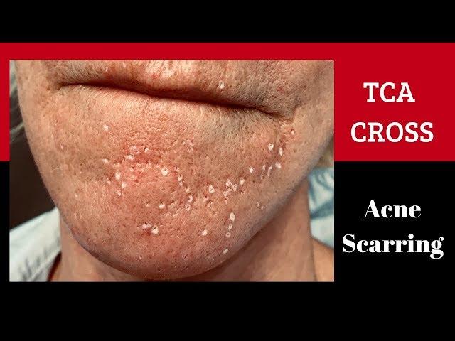 Dr. Weiner's technique for addressing TCA Cross for Acne Scarring