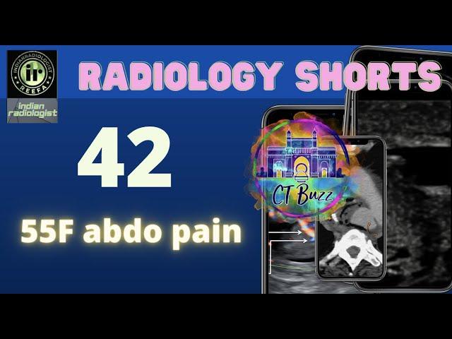 55F Abdo Pain - CT abdo | CTBUZZ2022 || #radiologyresident #radiology  | nobakbak | radiologyshorts