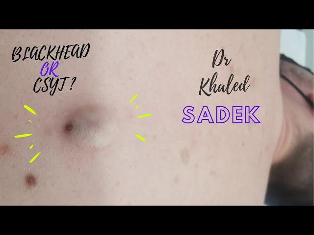 Blackhead or Cyst?! Dr Khaled Sadek. LipomaCyst.com