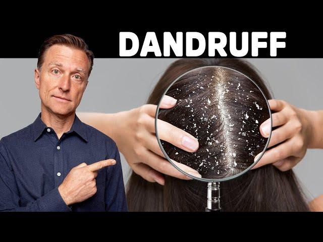 The REAL Cause and Cure for DANDRUFF