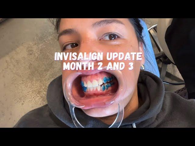 Invisalign update | month 2 and 3 | Invisalign buttons review