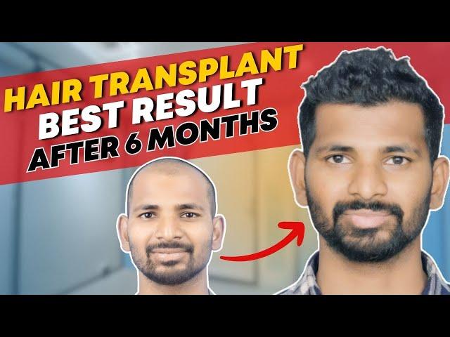 Hair Transplant in Chennai | Best Results & Cost of Hair Transplant in Chennai