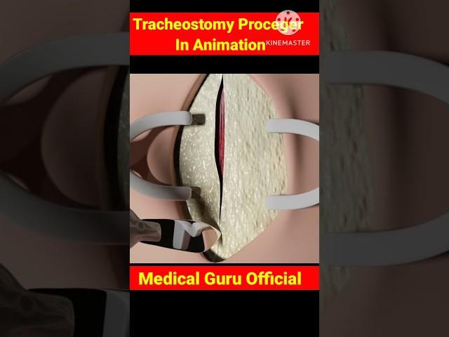 Tracheostomy Proceger In Animation Video #medicalshorts #youtubeshorts #medical guru official