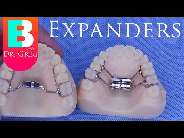 [BRACES EXPLAINED] Palatal Expanders