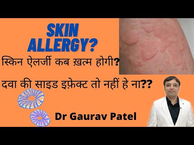 Skin allergy - स्किन ऐलर्जी कब ठीक होगी? Allergy की दवा की साइड इफ़ेक्ट तो नही हे?