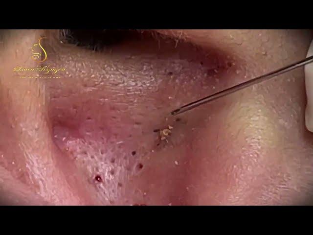 Relax squeezing out blackheads #13 Черные точки