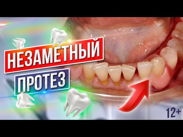 Частично Съемный БЮГЕЛЬНЫЙ ПРОТЕЗ на Нижнюю Челюсть