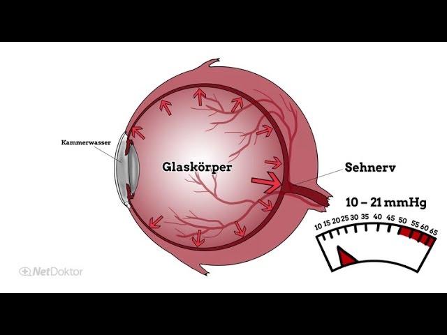 Wie entsteht Grüner Star? - NetDoktor.de