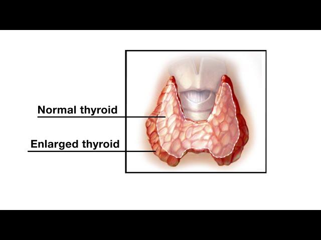 Mayo Clinic Minute - Thyroid overdrive – understanding Graves' disease