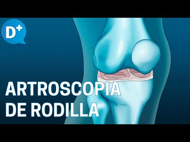 ¿En qué consiste la Artroscopia de rodilla?