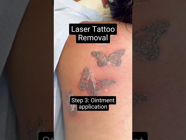 Laser Tattoo Removal