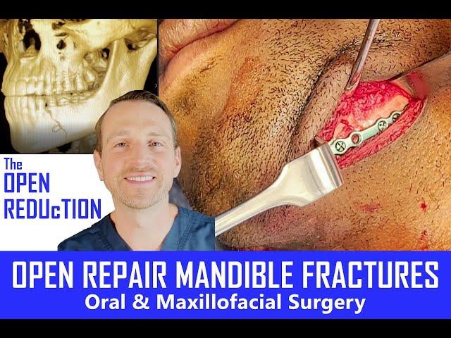 IN THE OR: BROKEN JAW SURGERY | MANDIBLE FRACTURE  REPAIR