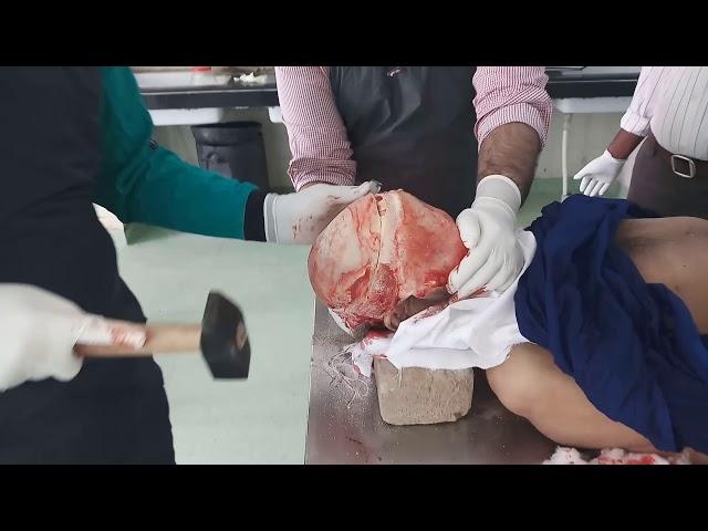 Steps of Autopsy Dissection