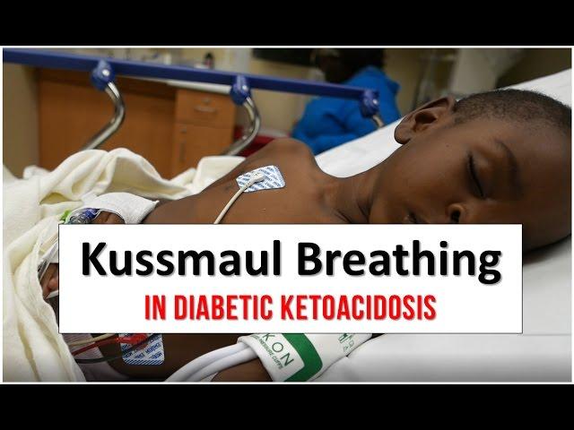 Kussmaul Breathing in Diabetic Ketoacidosis