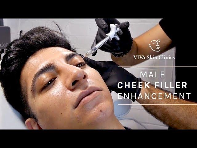 Male Cheek Filler Enhancement | VIVA Skin Clinics