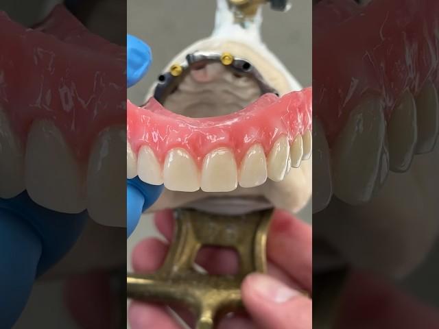 4-Locator Hybrid #Denture #dental #teeth #smile #lsk121shorts @EnvisiontecMain #envisiontec