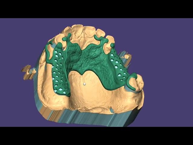 REMOVABLE PARTIAL DENTURE #design