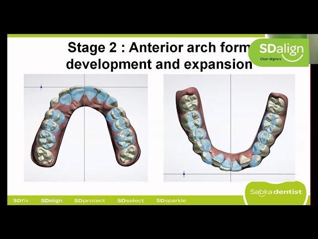 Webinar – Participate in the actual planning of an aligner case on 3Shape Ortho Systems.