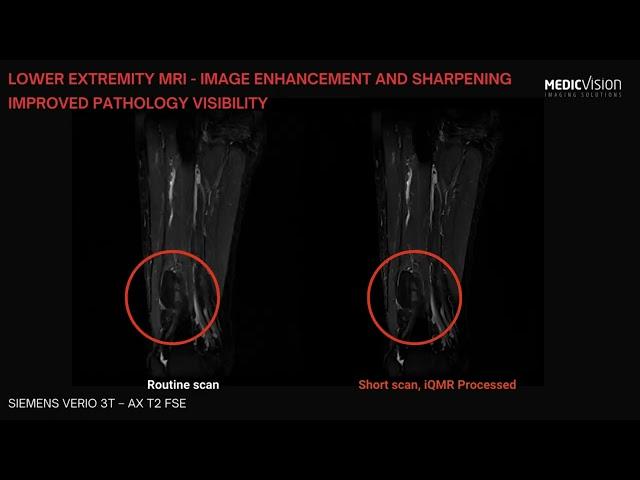 Enhanced Lower Extremity MRI scans Improve Intramuscular lipoma visibility