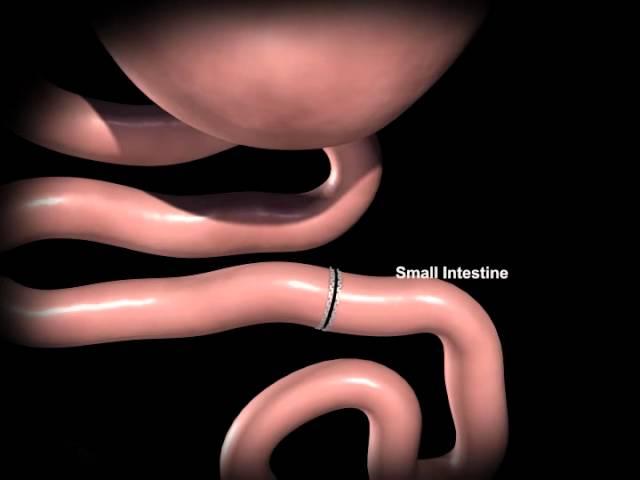 Rex Bariatrics: Gastric Bypass Surgery Explained