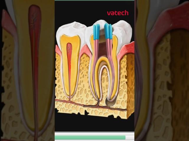 Воспаление корня зуба наглядно в программном обеспечении #vatech #стоматология #зубы