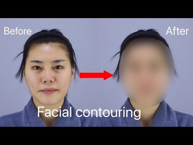 Face Contouring and Rhinoplasty  | Seoul Guide Medical