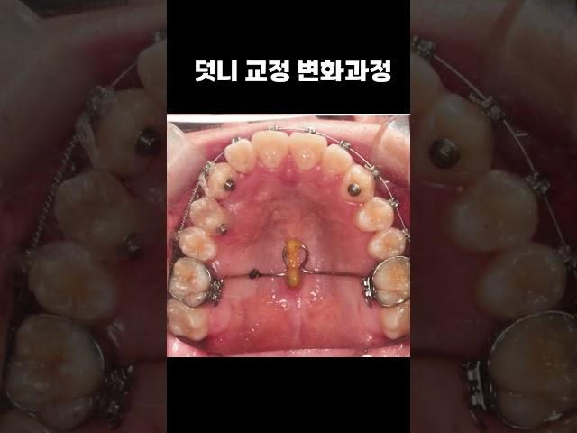 덧니교정 변화과정