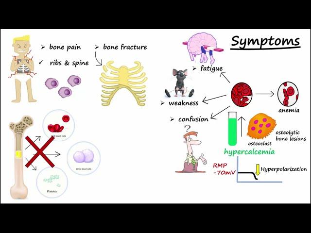 Multiple Myeloma