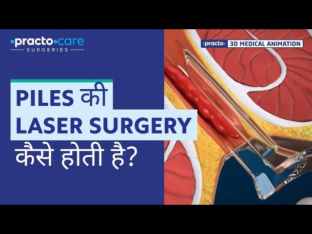 Piles Laser Surgery | Procedure Animation | Best Treatment for Piles | Practo Care Surgeries