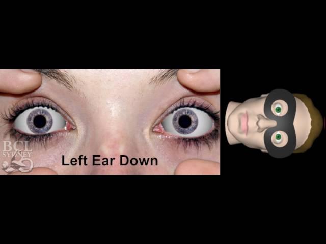 Right Horizontal Canal BPV (Benign Positional Vertigo)