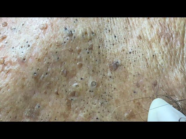 Acne treatment for Spa Linh Mun 2024 #47