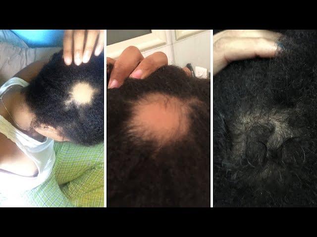 My Bald Spot Journey!