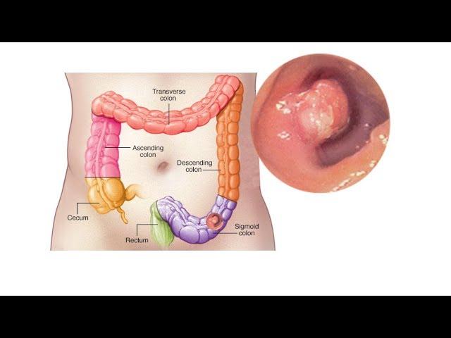 Mayo Clinic Minute: Symptoms of colon cancer