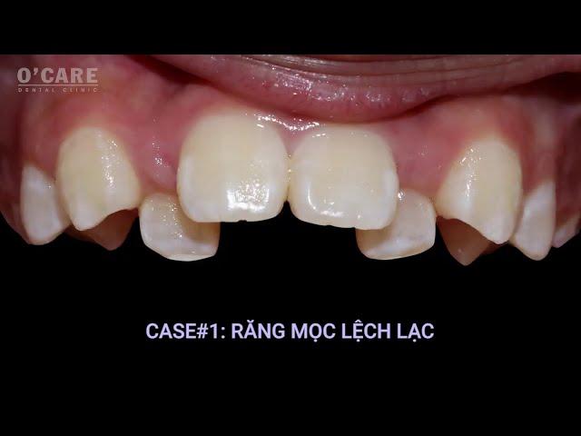 Sự thay đổi của hàm trên khi niềng răng | Upper jaw braces