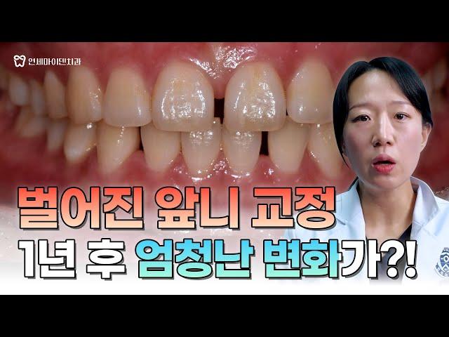 Correction of gaping front teeth, a huge change after 1 year?!