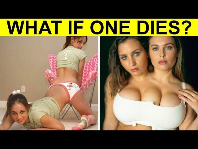 Unseen World of Siamese Twins - Top 15 Extraordinary Cases