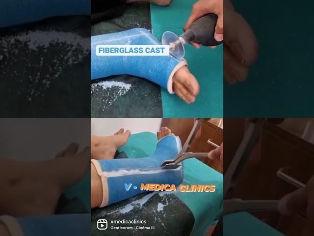 Fibreglass cast and its removal.