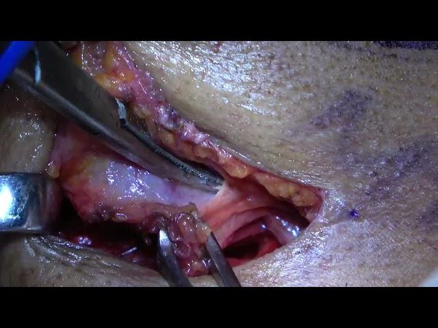 Submandibular gland excision