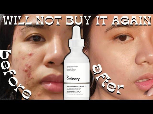 6 MONTHS OF THE ORDINARY NIACINAMIDE | I will stop  using it on my acne skin *not a clickbait* !!